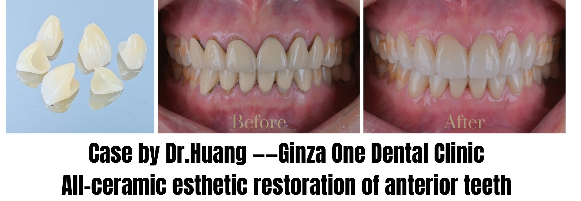 Ginza ONE Method — Designing the Natural Smile