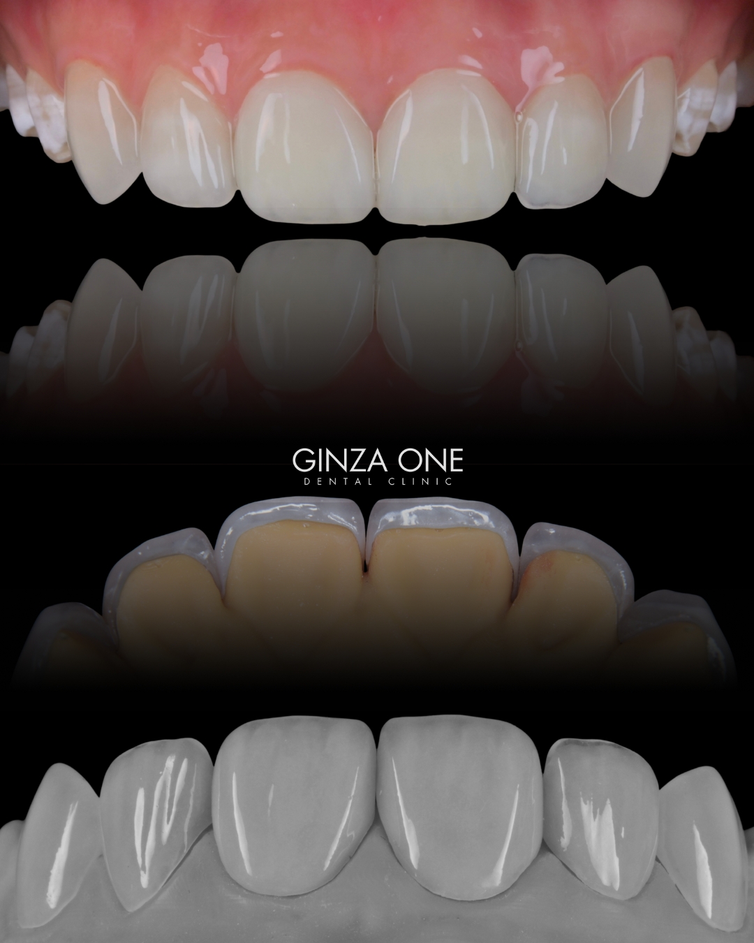 前牙美学设计:医生到底在设计什么?
