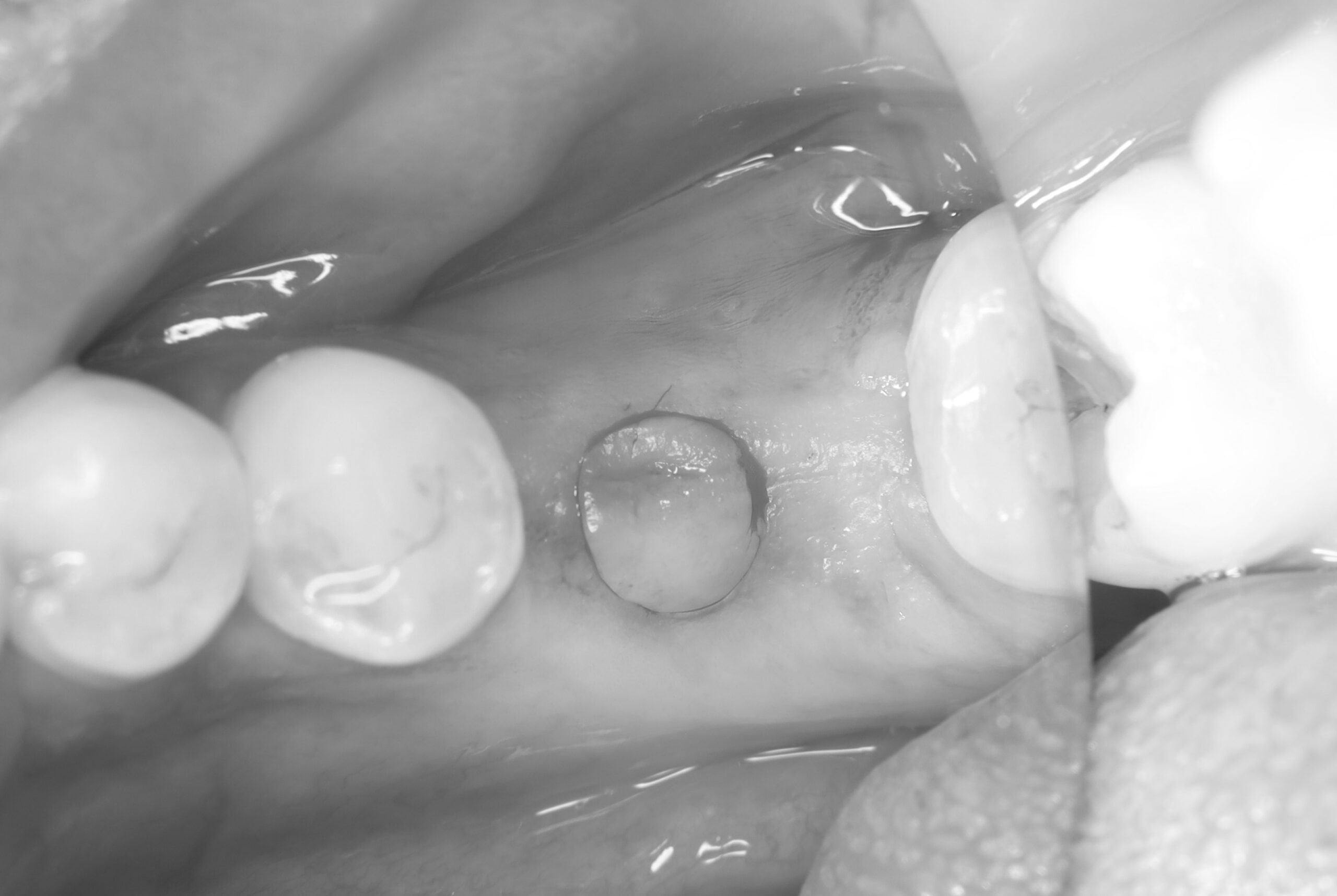 インプラント＝怖い」は本当？