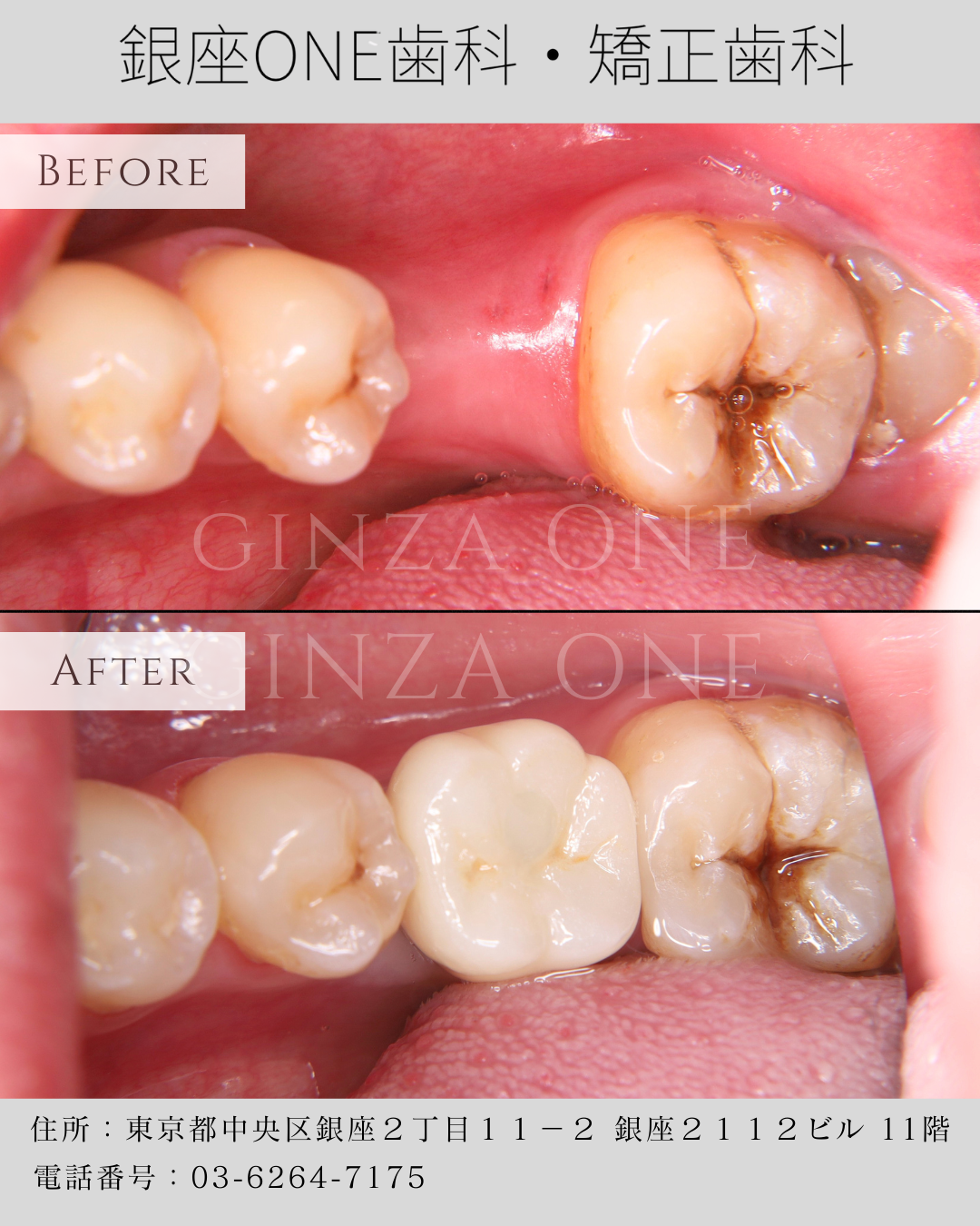 Is “Implant = Scary” Really True?