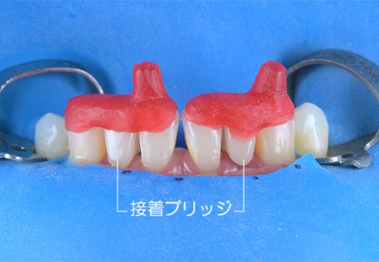 接着ブリッジ