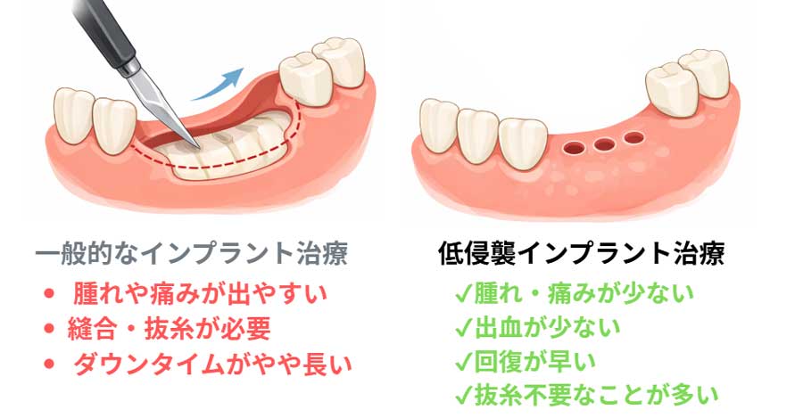 歯茎を切らない低侵襲インプラント治療