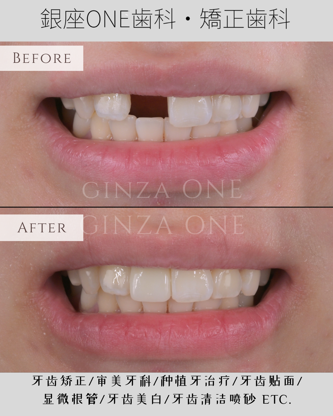 インプラント＝大手術？低侵襲治療でここまで変わります