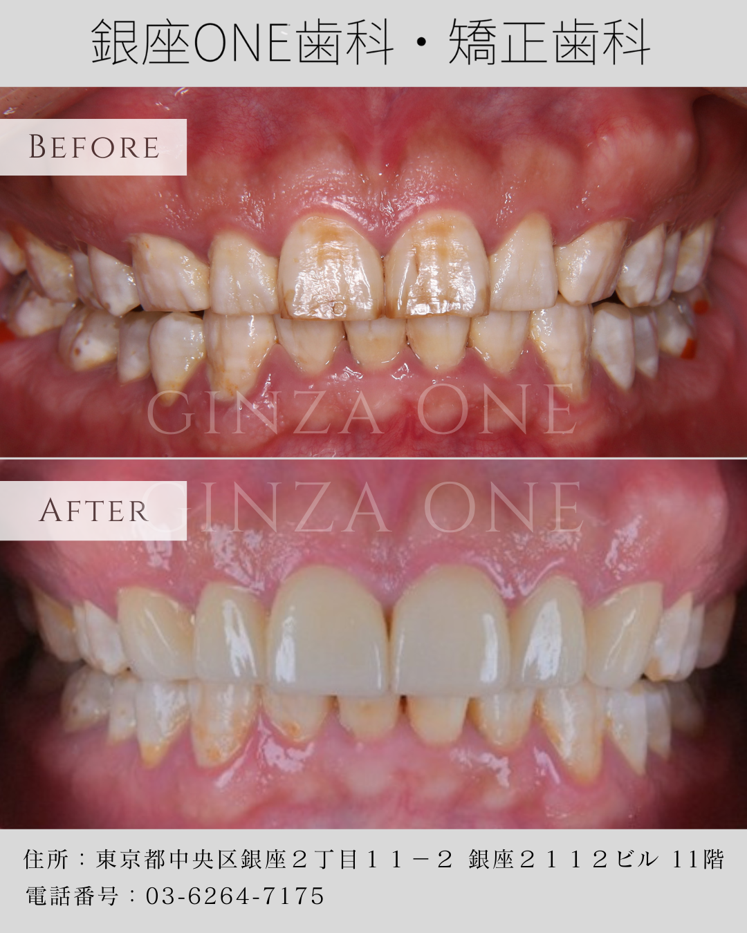 3 Types of People Who May Benefit from Laminate Veneers