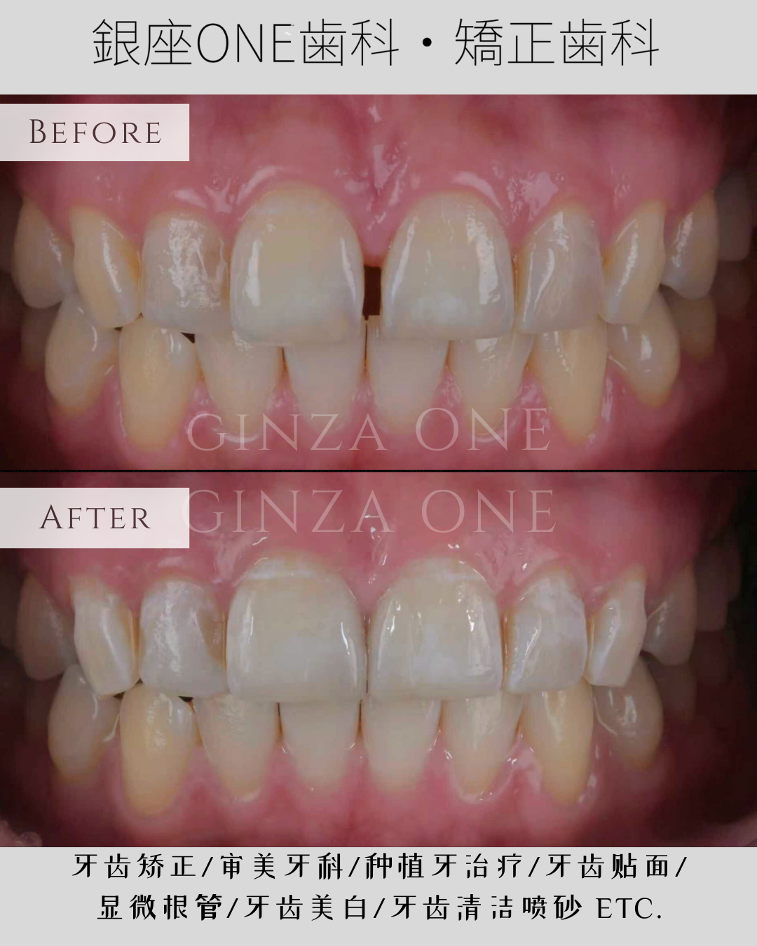 前歯のすき間を自然に改善する方法― 部分ラミネートベニアという選択 ―