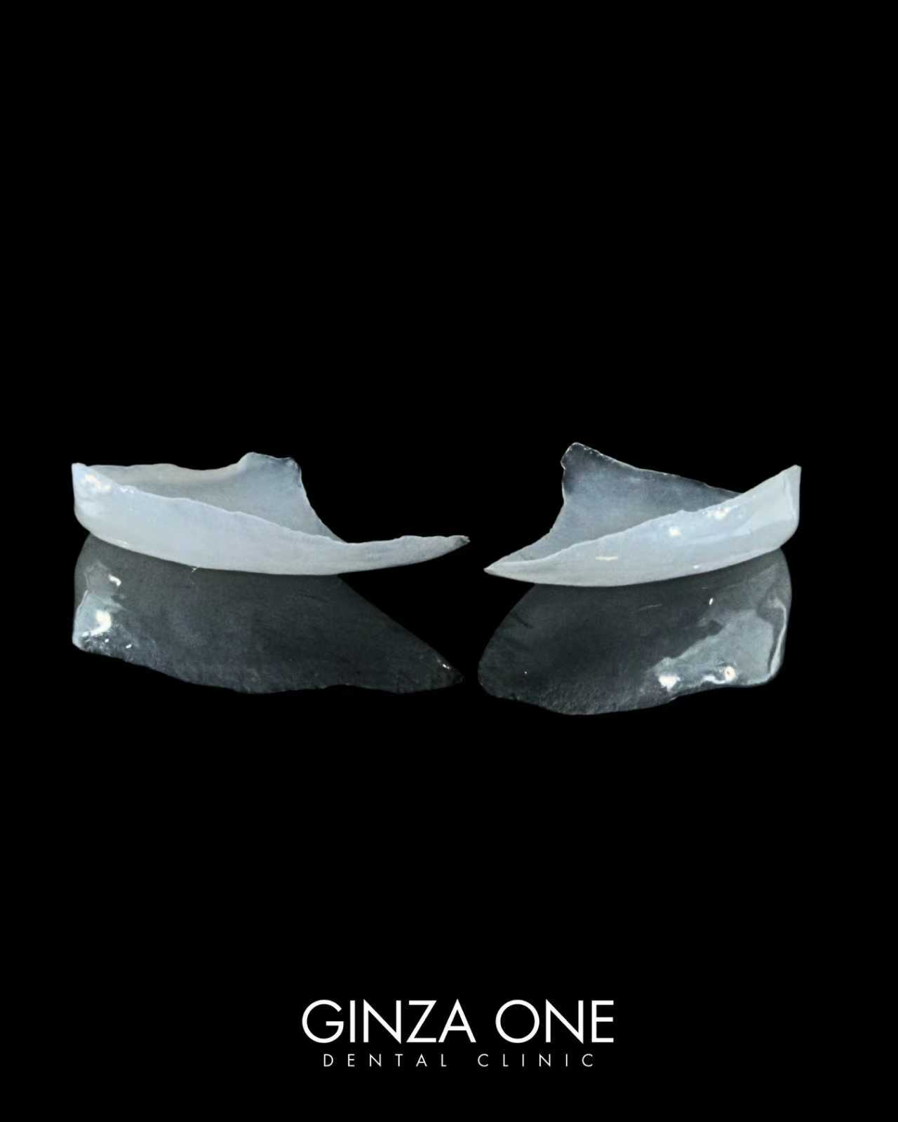 Closing Small Gaps Between Front Teeth— A Minimally Invasive Aesthetic Approach with Partial Laminate Veneers —