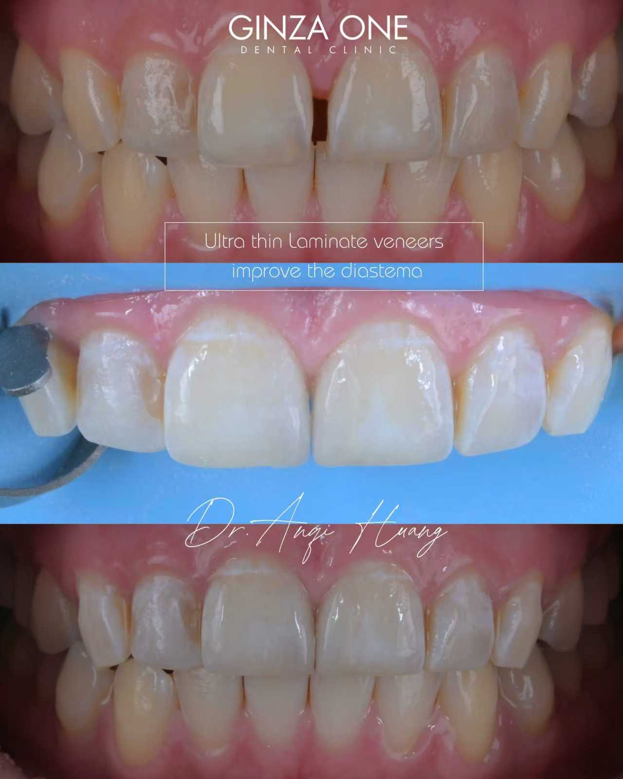 不用矫正，也能自然改善门牙缝隙