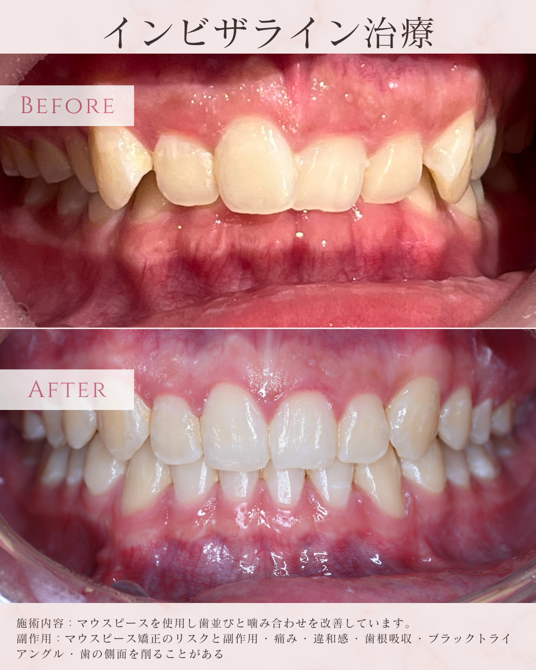 矫正一定要拔牙吗？很多人一开始就想错了方向｜银座ONE齿科・矫正齿科