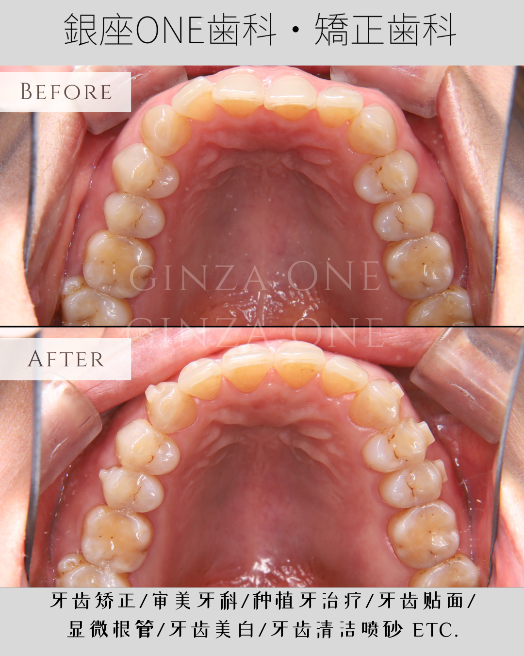 🦷 What Are Attachments in Clear Aligner Treatment?