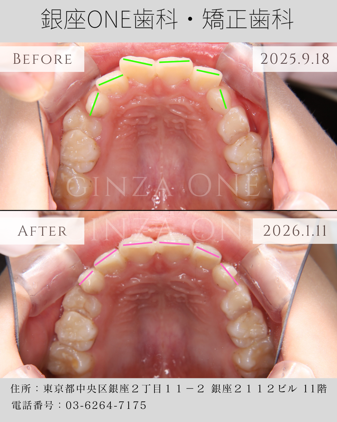 🦷 アタッチメント（小さな白い突起）とは？役割・見た目・必要性を分かりやすく解説