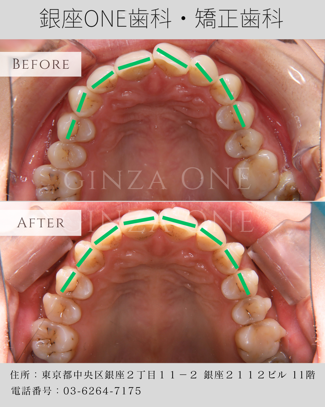 🦷 アタッチメント(牙齿上的“小白点”)是什么?90%的人其实并不了解