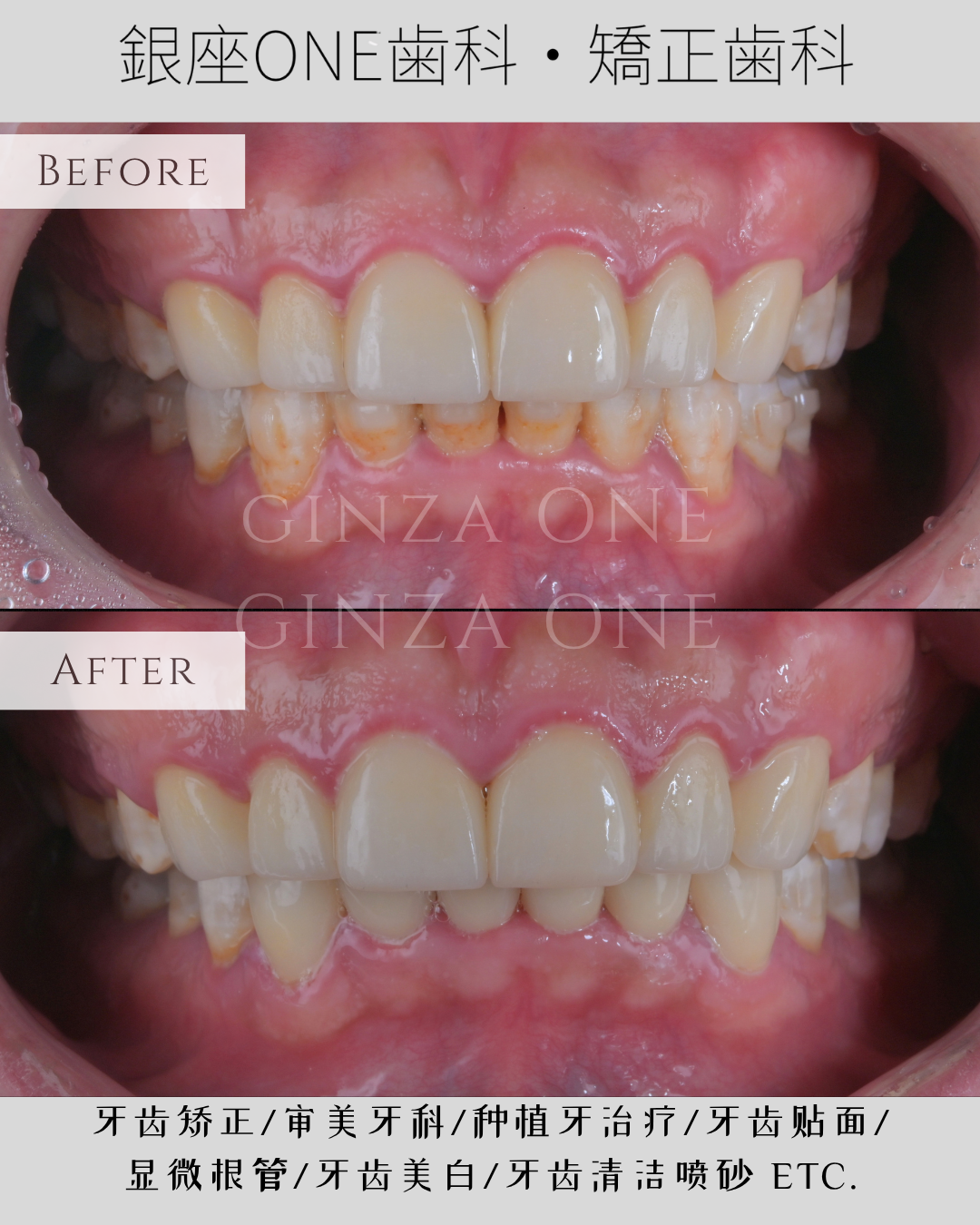 Solutions for dental esthetic 審美歯科　写真集 審美歯科-esthetic｜銀座ONE歯科・矯正歯科｜銀座一丁目、有楽町、銀座