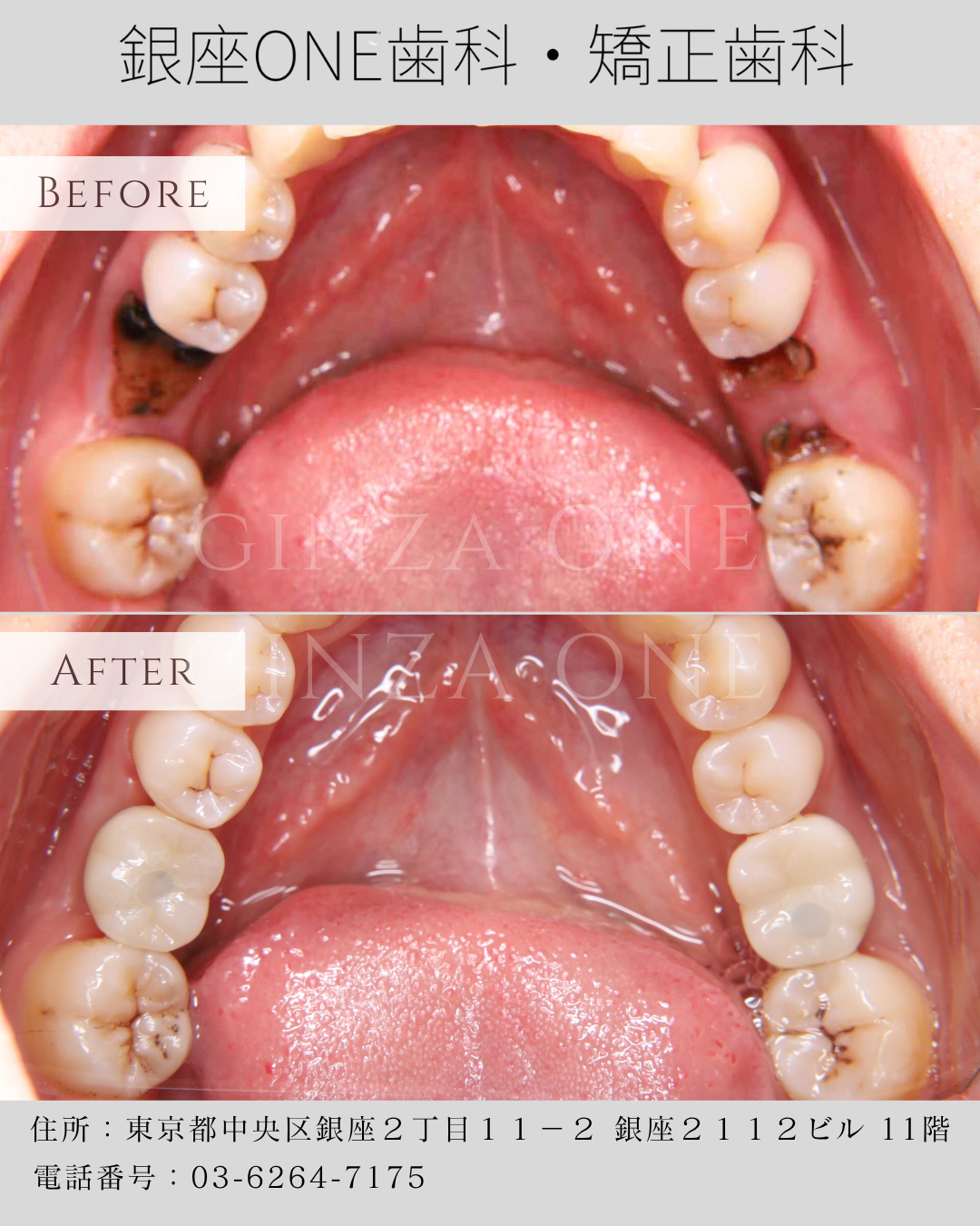 Why Does Your Face Look Older After Losing a Back Tooth?