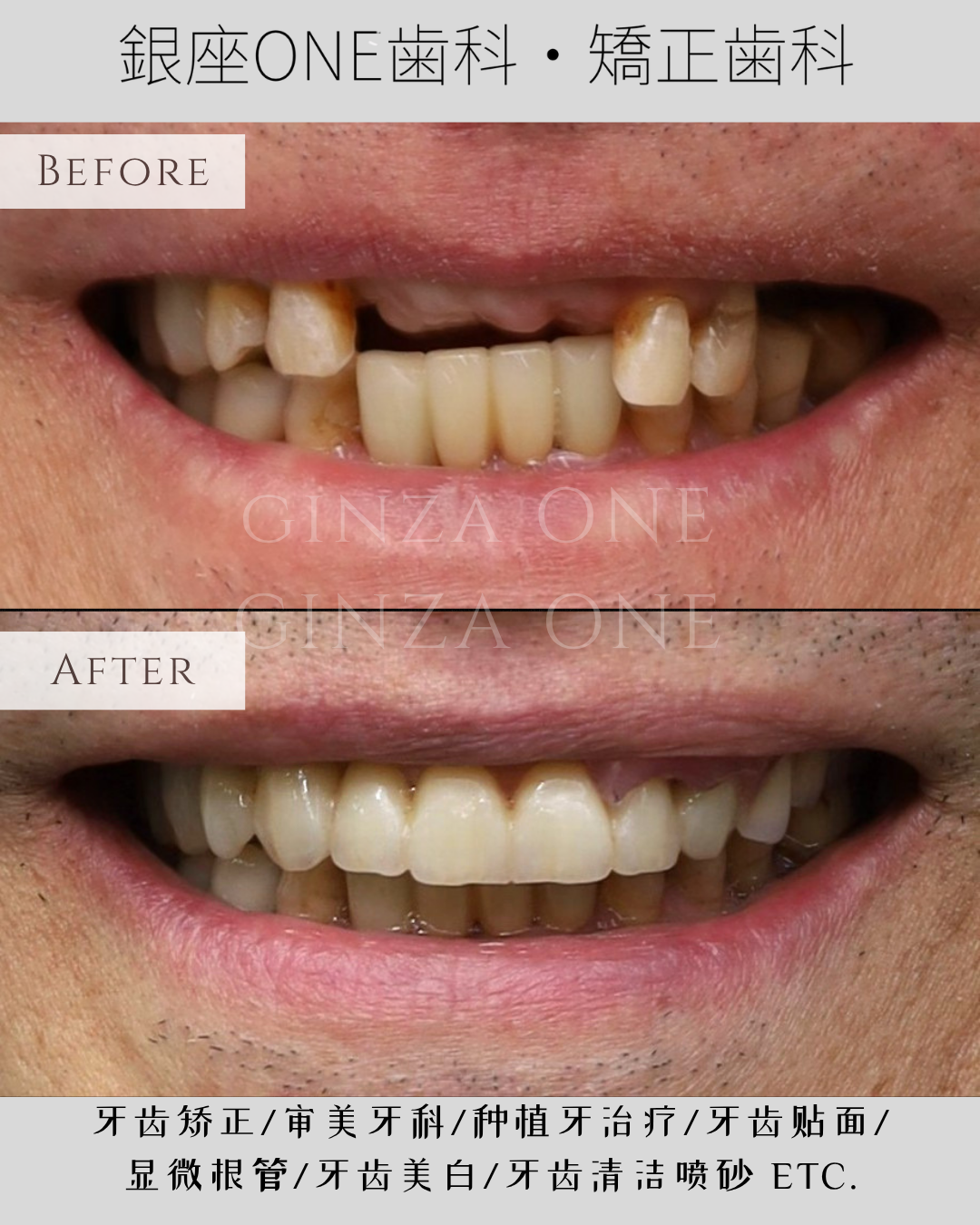 🦷 Family Dental Implant Consultations for Elderly Patients