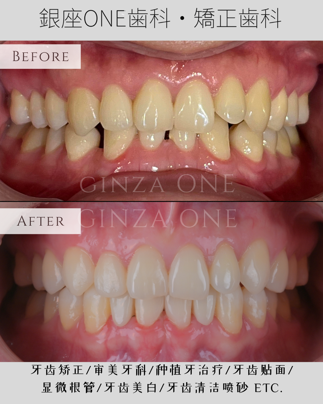【矯正＝抜歯は本当に必要？】その判断、まだ早いかもしれません｜銀座ONE歯科・矯正歯科