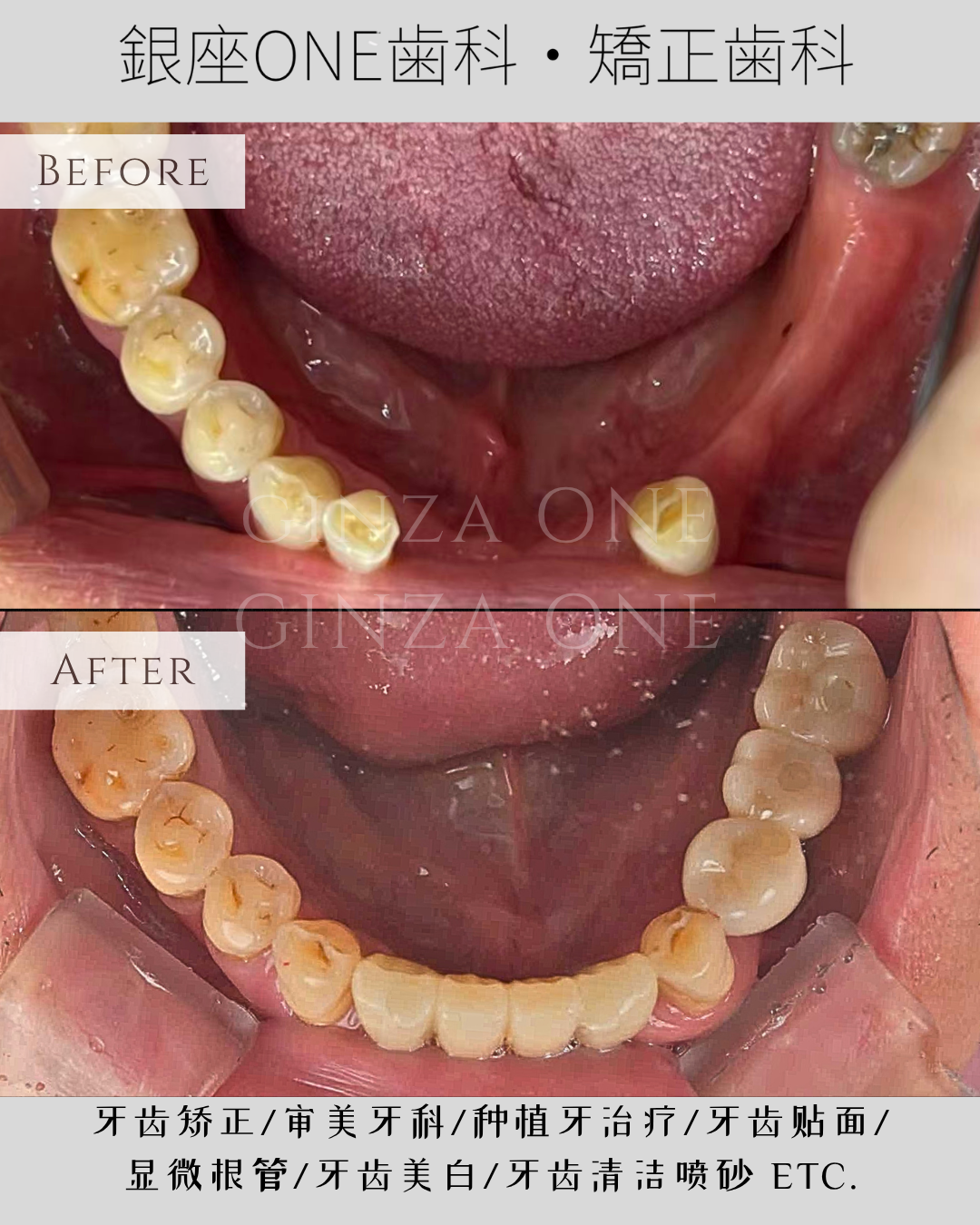 🦷 親御様を連れてインプラント相談へ
