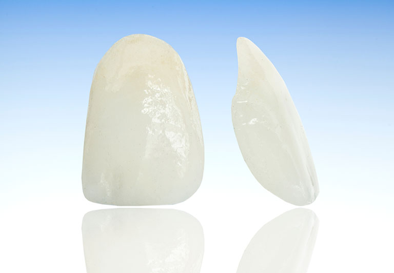 ラミネートベニア