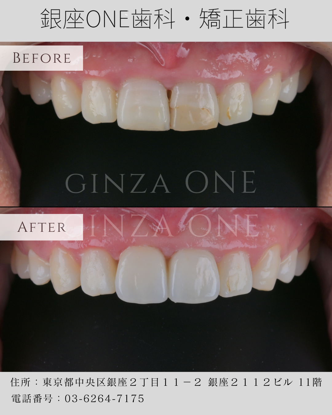 Why Do Front Teeth Sometimes Look Unnatural After Root Canal Treatment?