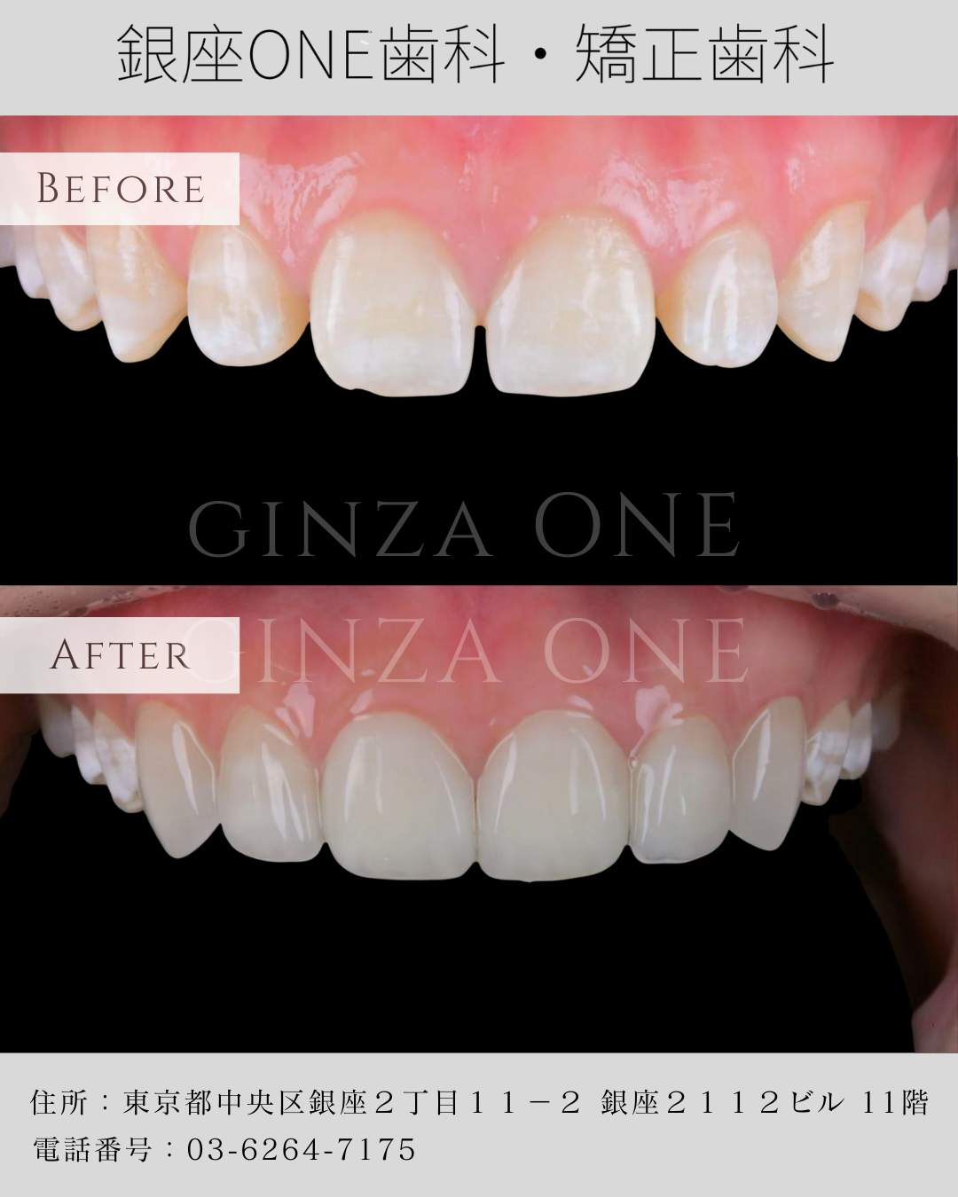 Do Teeth Have a “Youthful” or “Mature” Look?