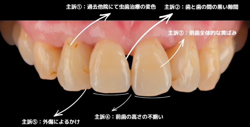 ラミネートべニア治療施術前のお悩み