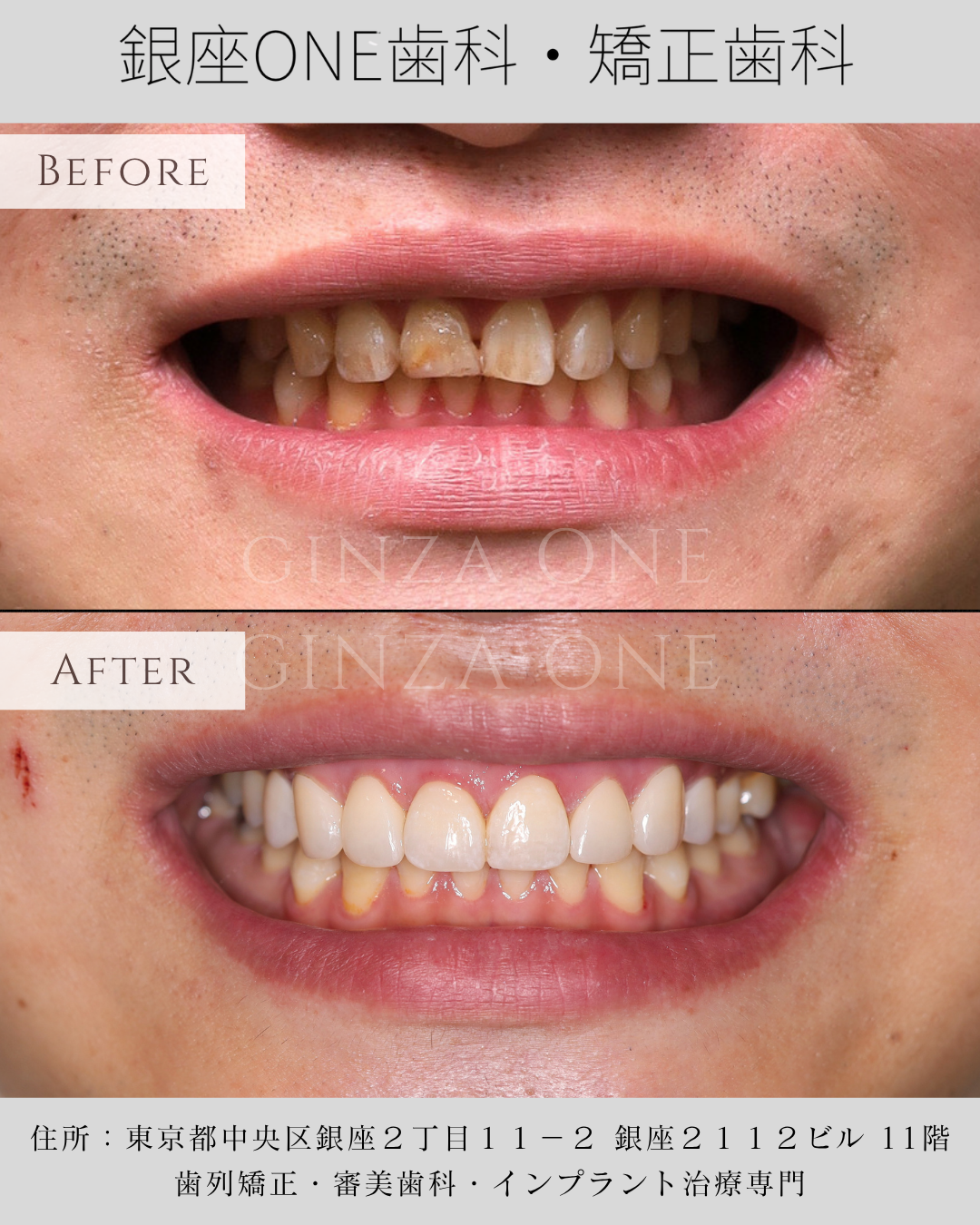 Looking Older? It May Not Be Wrinkles — It Could Be Your Front Teeth