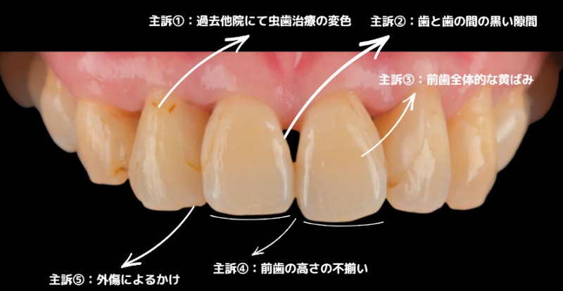ラミネート治療前の歯の状態