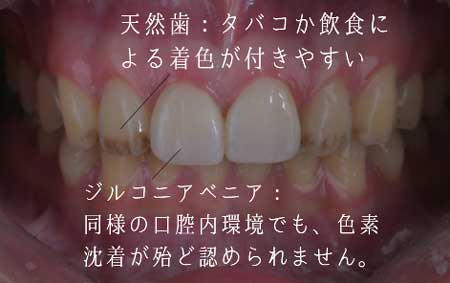 汚れが付着しにくく、強度と透光度が高い高品質「ジルコニア」を採用
