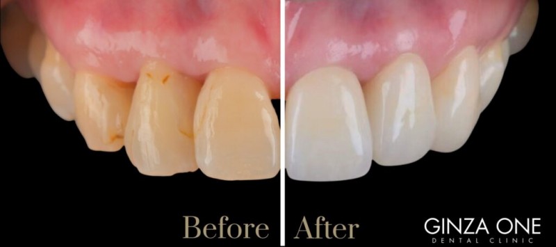 ラミネートベニア治療のBefore、After