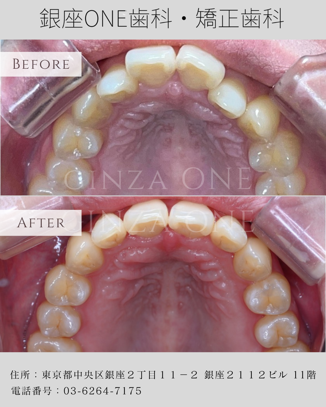 Why Do You Still Get Cavities and Tartar Even If You Brush Every Day?