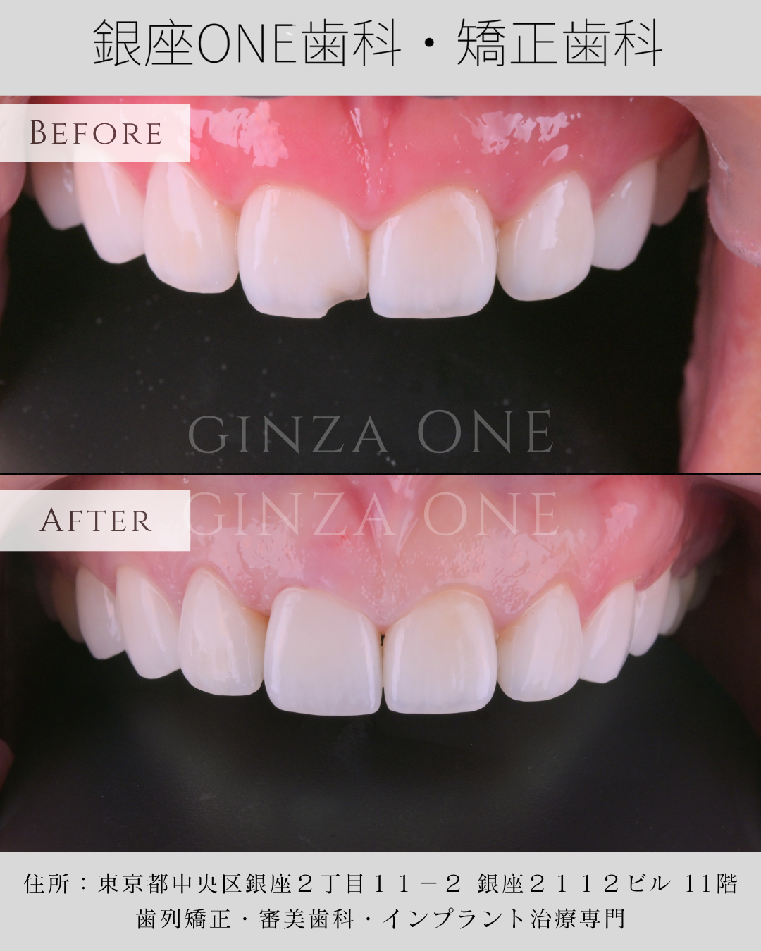 Why More Patients Are Choosing Digital Anterior Aesthetic Dentistry