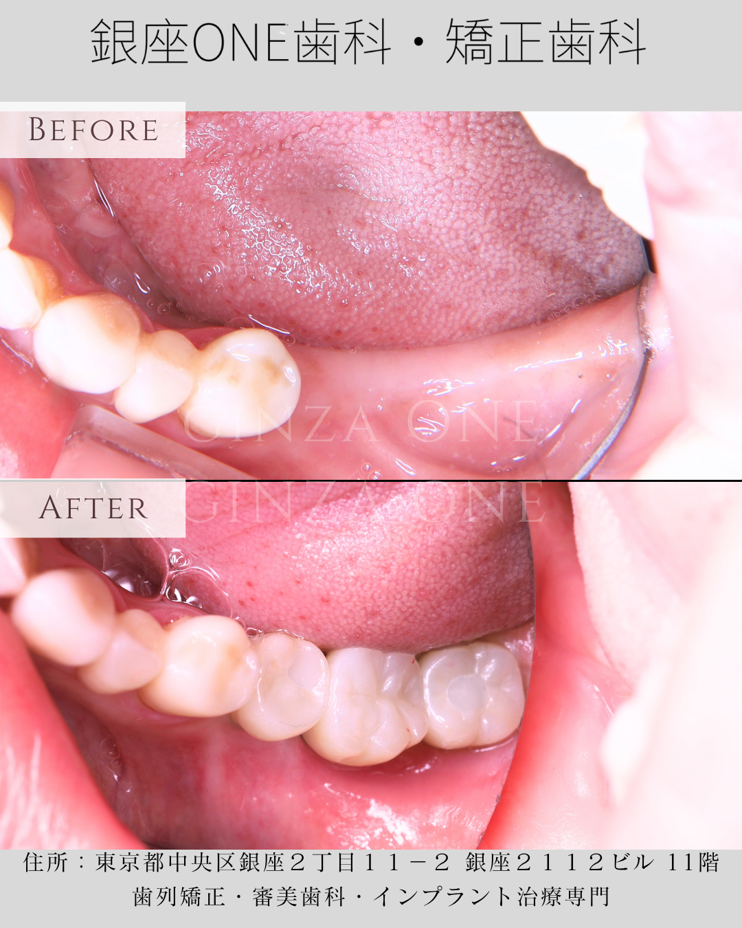 Missing One Back Tooth? Why You May Be Overworking the Other Side