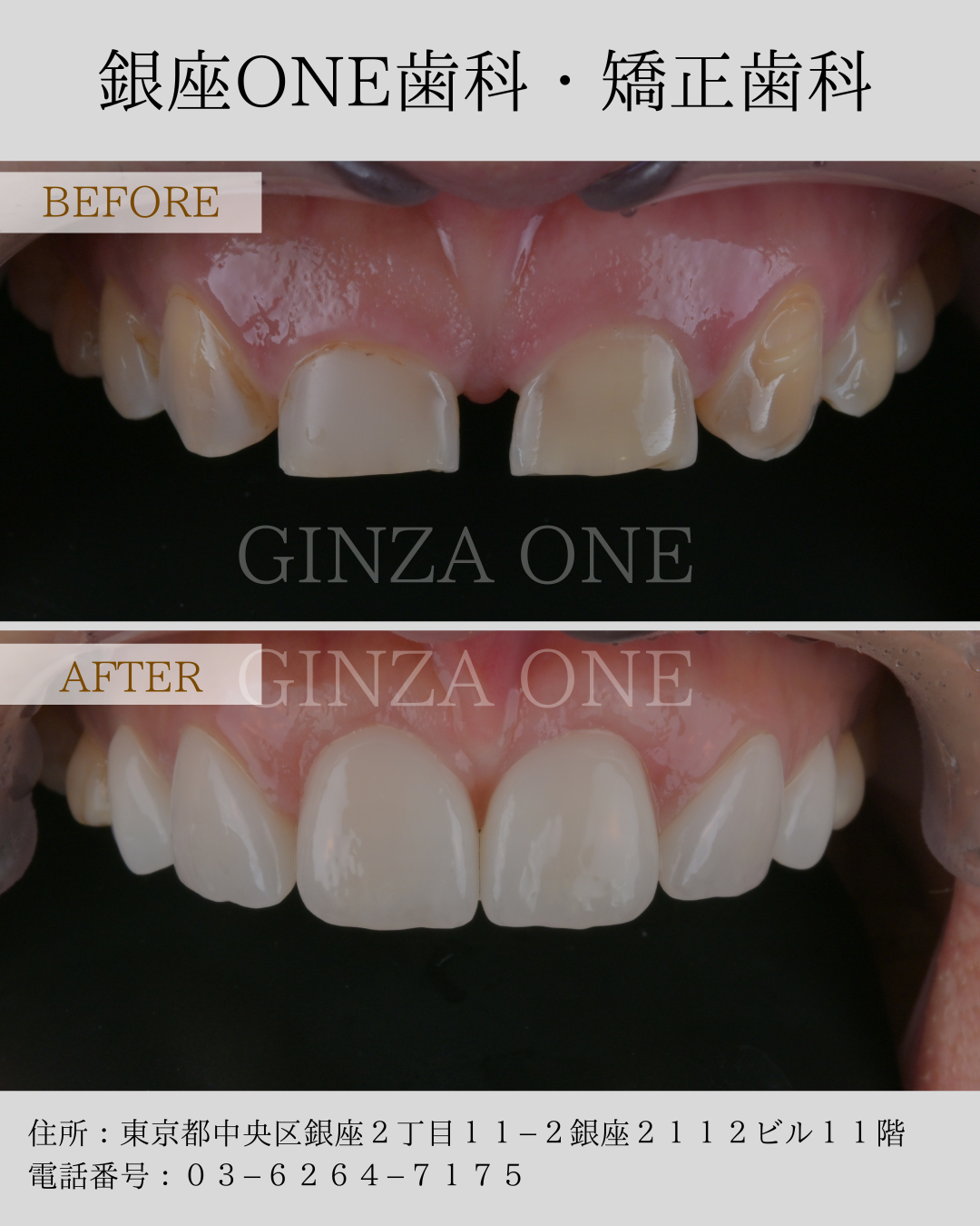 🦷 Considering Laminate Veneers but Worried About Tooth Preparation?